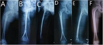 Operative choice for subtrochanteric femoral fracture in school-aged children: Triple elastic stable intramedullary nail versus locking plate